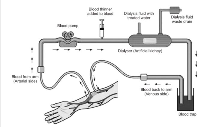 Hesi case study chronic renal failure